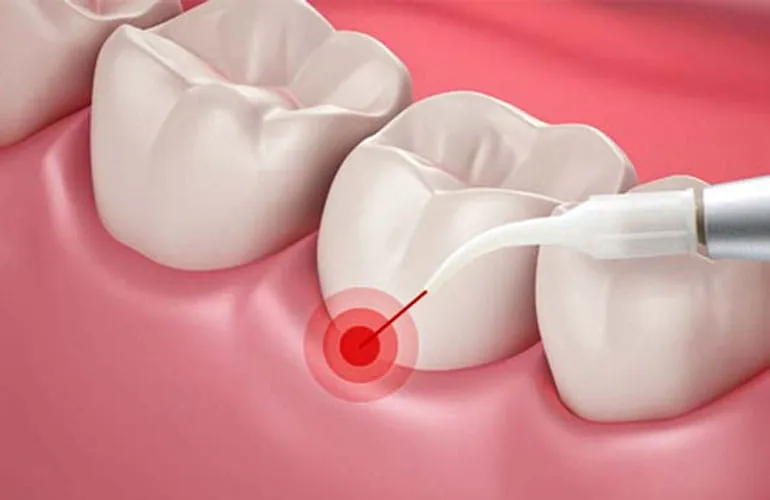 Laser Periodontal Therapy