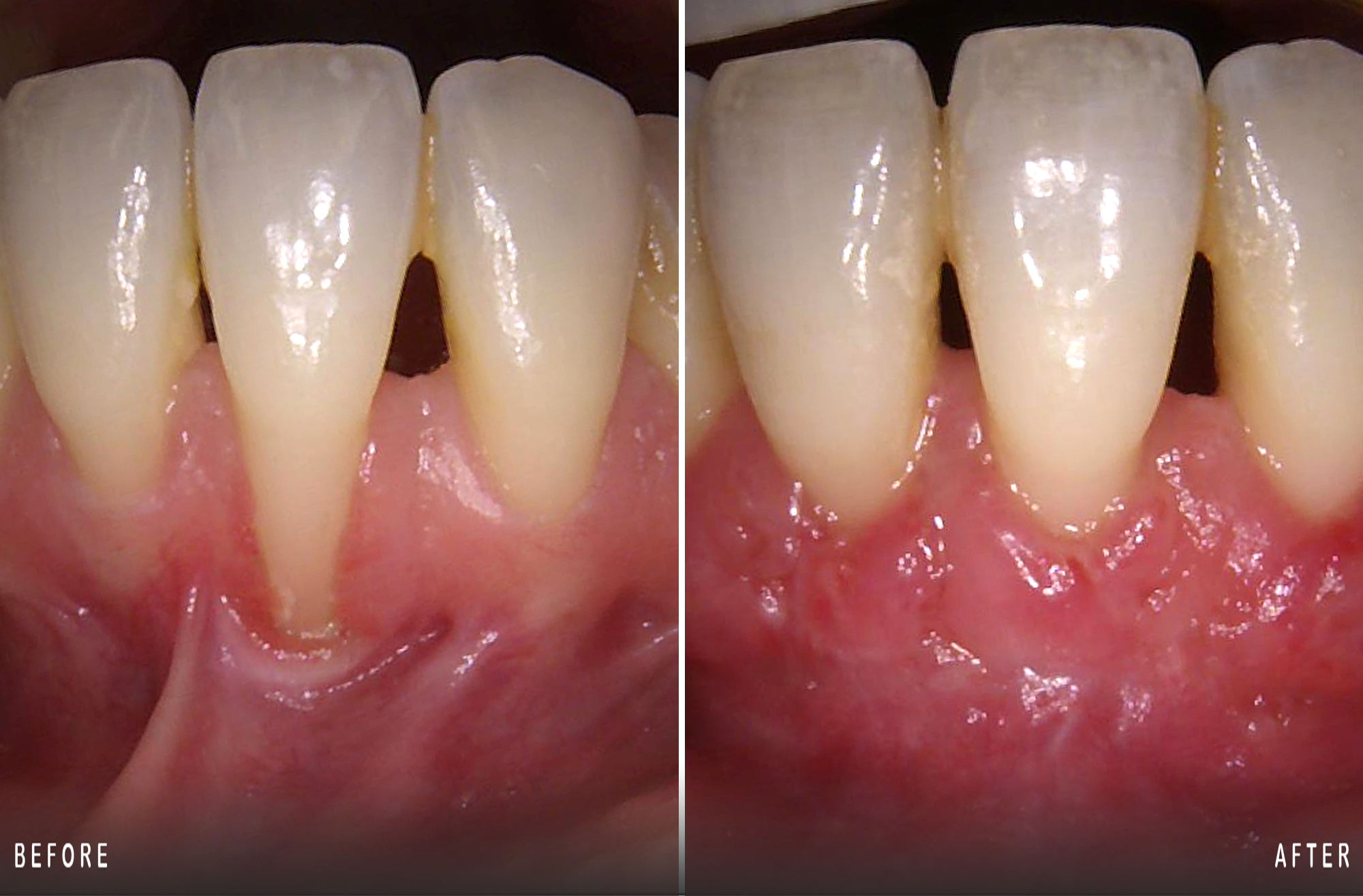 Soft Tisue Graft To Correct Root Recession