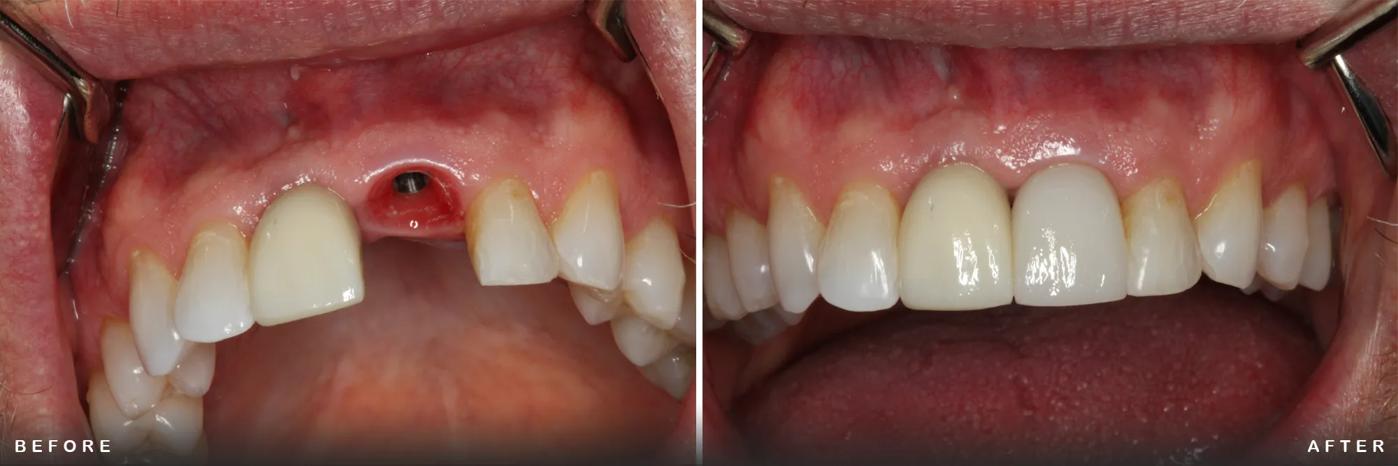 Single Tooth Replacement with a Dental Implant