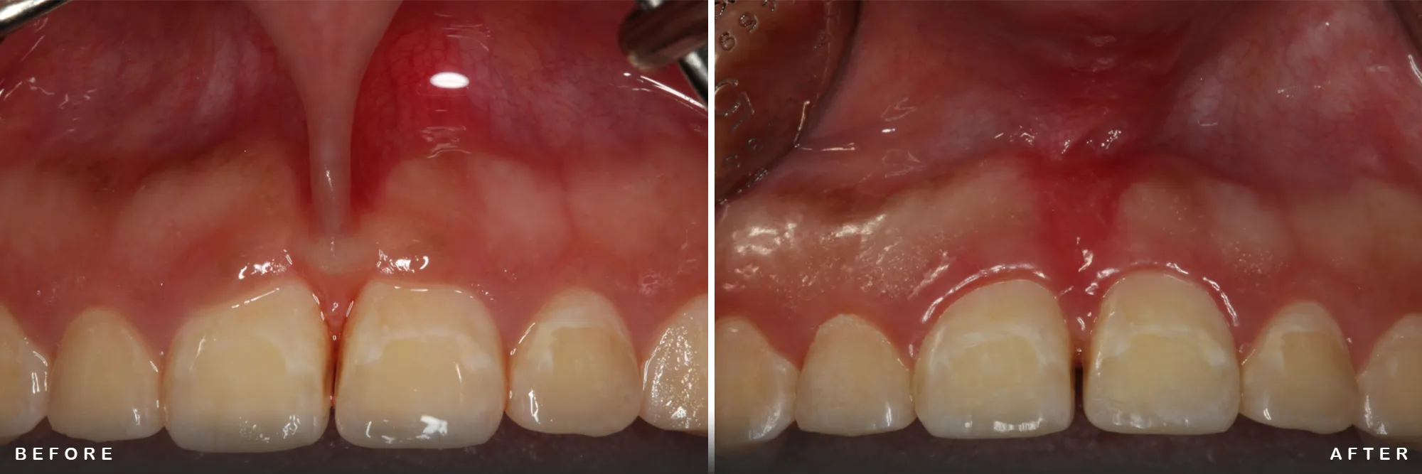 Frenectomy Procedure