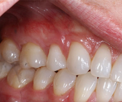 Correction of receding gum level (soft tissue Graft)After