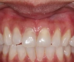 Dental Implants After