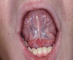 Frenectomy After 1