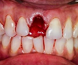 dental implant before