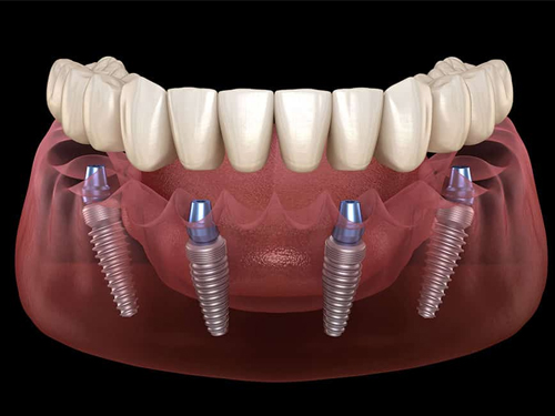 Dental Implants Moreno Valley