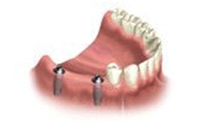Multiple Dental Implants Course of Treatme Moreno Valley