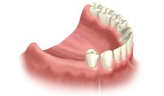 Multiple Dental Implants Course of Treatme Riverside