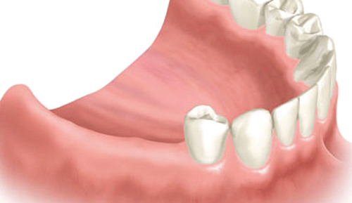 Multiple Missing Teeth Dental Implants Moreno Valley