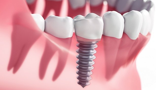 Single Tooth Dental Impants Riverside