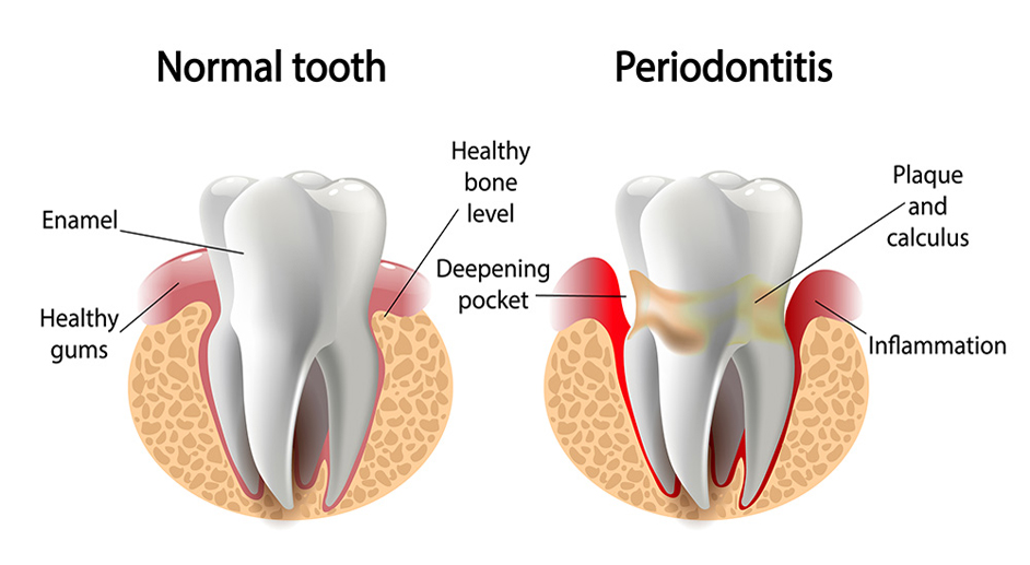 Osseous Surgery Riverside/Moreno Valley Periodontist